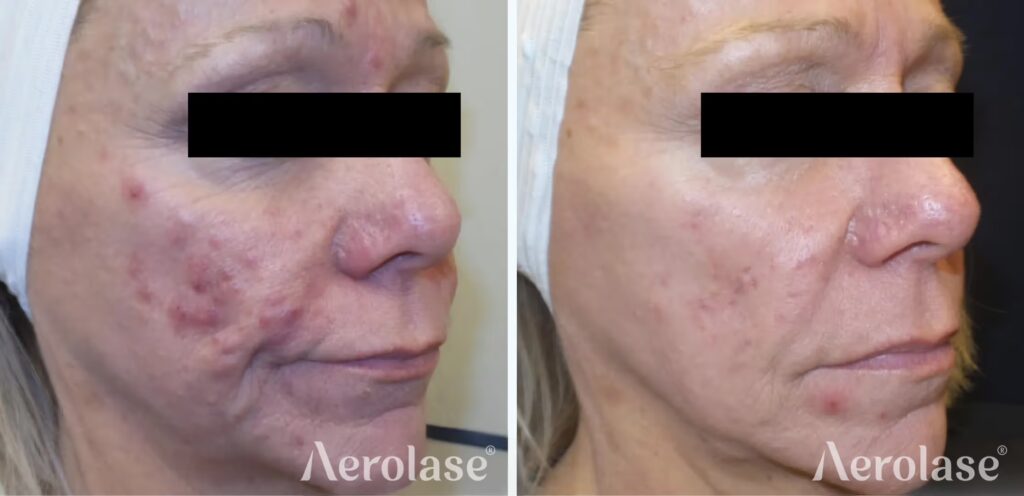 679c9867164f379f7f2dcb2d_111acne-cystic-pinski-before-and-after