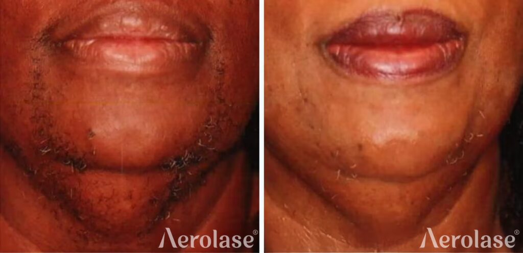 679cf2d85fb58f20d358e821_111hair-removal-cheryl-burgess-before-and-after-1 (1)
