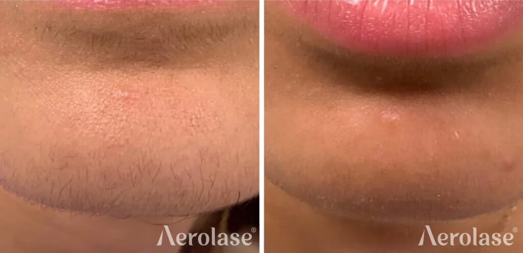 679cf3c27152e45b714e81f2_hair-removal-photo-courtesy-of-nicole-osterling-np (1)