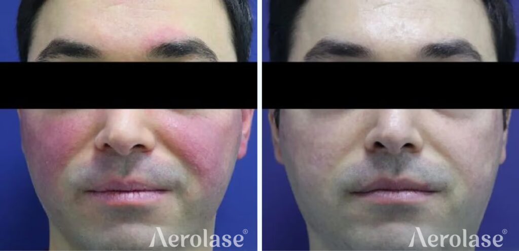 679cf7a22a51a06372df3ed8_111redness-nabil-fakih-before-and-after