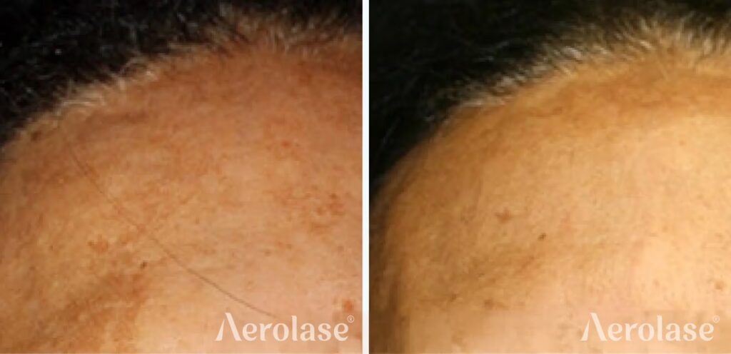 67a07cd1c04beeb631bc7ae9_111melasma-3-cheryl-burgess-before-and-after