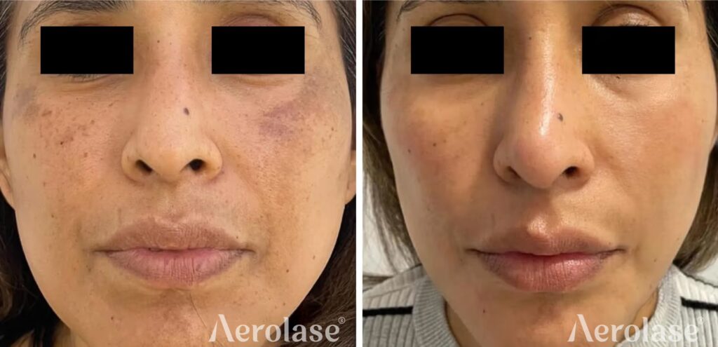 67a07fc783496c57aec6465f_melasma-before-and-after-clinica-burgos