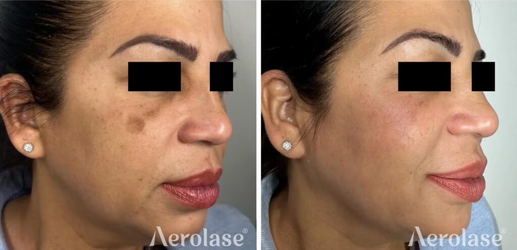 67a07ff29bdd85fb6e7ff7bd_melasma-before-and-after-zoe-flor